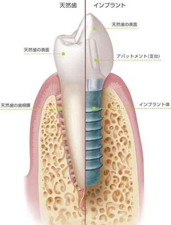 天然歯（ご自身の歯）とインプラントとの違い